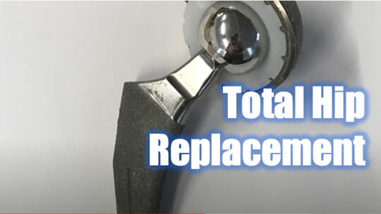 What's Hip Replacement made out of?